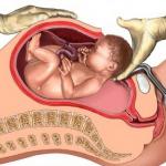 الولادة القيصرية .. أسباب ومشكلات